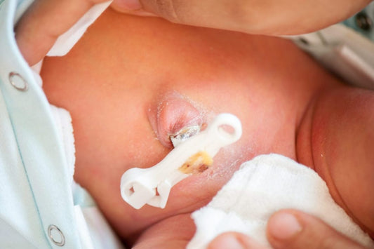 UMBILICAL HERNIA